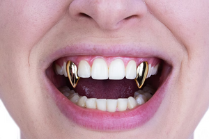 Close-up of a person's mouth wearing two gold vampire fang tooth grills on the front teeth.