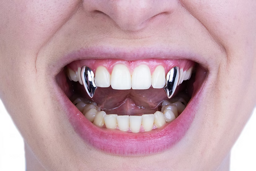 Close-up of a person's mouth wearing two shiny silver tooth guards over the front teeth, with lips parted and teeth visible against a plain white background.