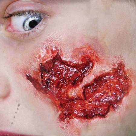 skin prosthetic wound transfer